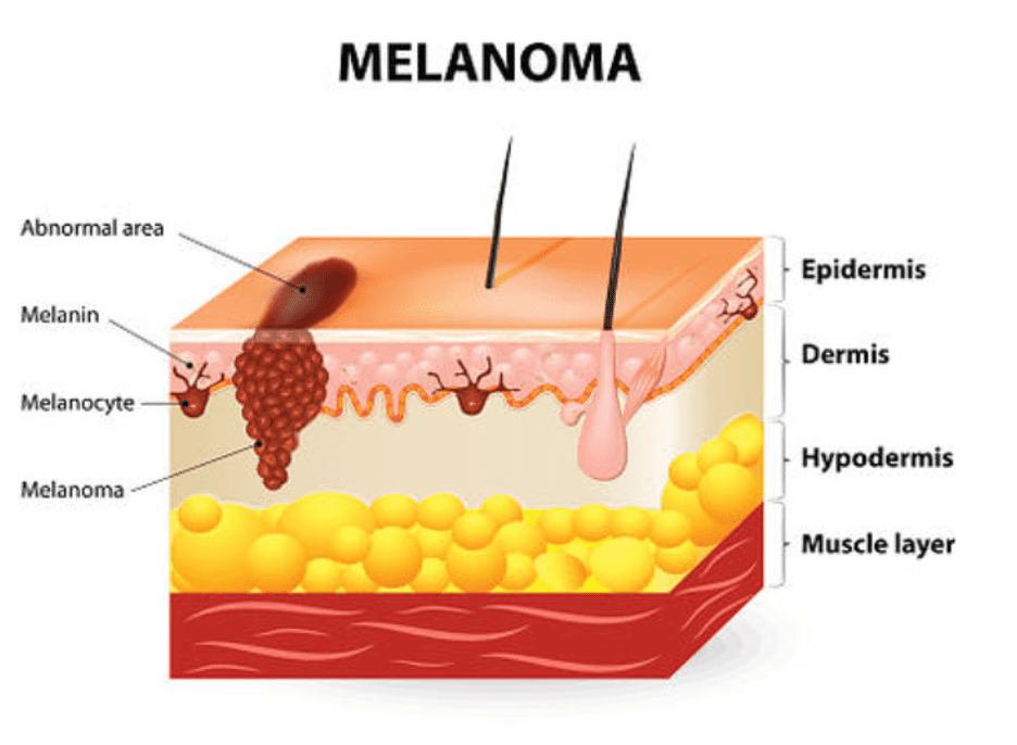 A crosssection diagram of skin showing a melanoma