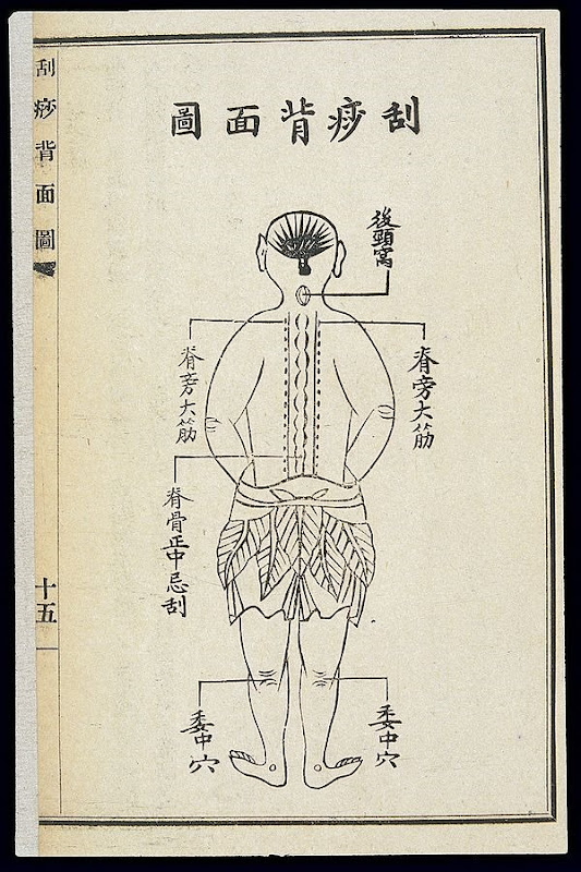Back-view illustration of Gua Sha treatment from Fangyi chuyan (A Modest Proposal for Epidemic Prevention)